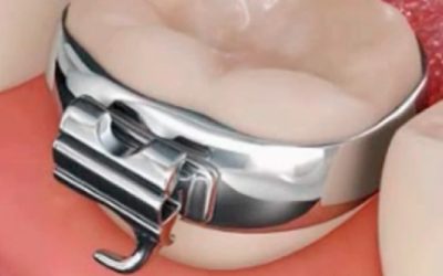 Anéis e bandas ortodônticas