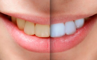 Clareamento dental: qual o melhor?