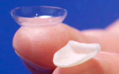 Lente de contato dental em Porto Alegre