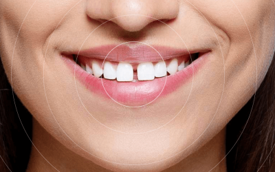 Diastema