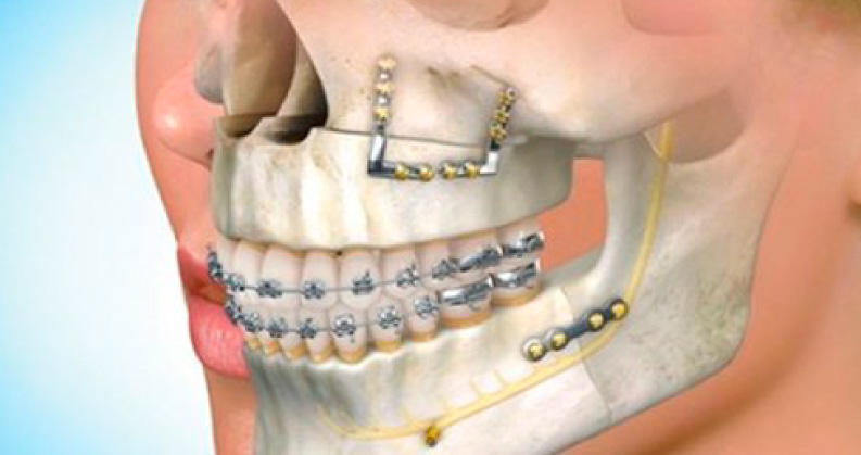 Ortodontia e cirurgia ortognática