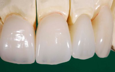 Prótese metalocerâmica x metalfree