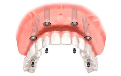 Substituição de dentaduras por proteses fixas sobre implantes