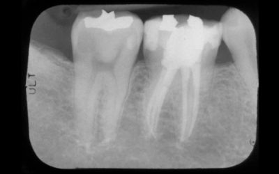 Tratamento de canal enfraquece o dente?