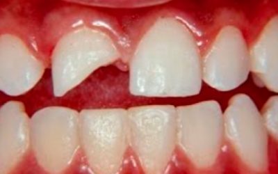 Traumatismos dentais