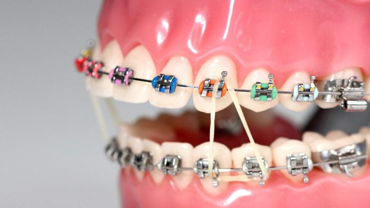 elásticos ortodônticos