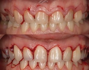 cirurgia plástica gengival