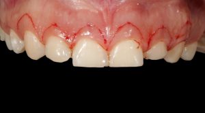 plastia gengival