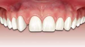 Agenesia Dental