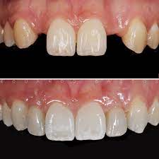 agenesia dental