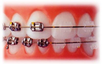 Dúvidas sobre Aparelho Ortodôntico