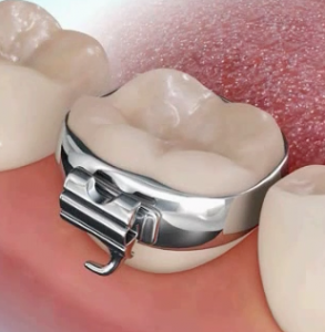 banda ortodôntica cimentada