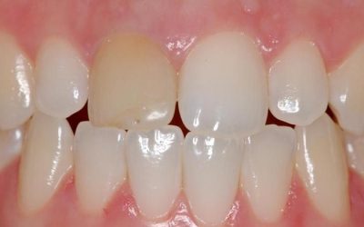 Meu dente escureceu!?