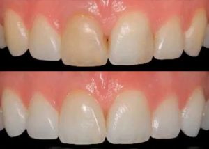 dente escuro