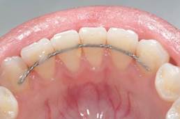 contenção fixa reta