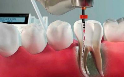 Tratamento de canal mecanizado