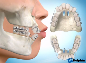 aparelho com  4 extrações