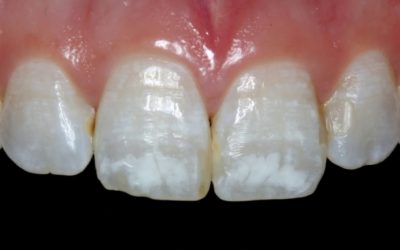 Manchas nos dentes