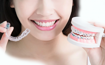 Como Limpar o Aparelho Ortodôntico