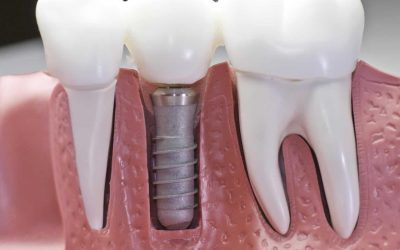 Implante Dentário
