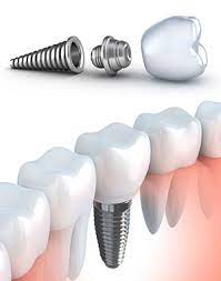 peças do implante dentário