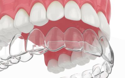 Alinhador invisível vale a pena mesmo?