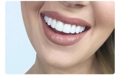 Quem pode usar lente dental?