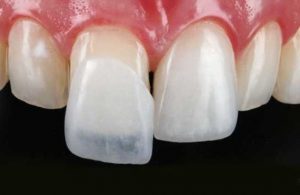 lente de contato dental
