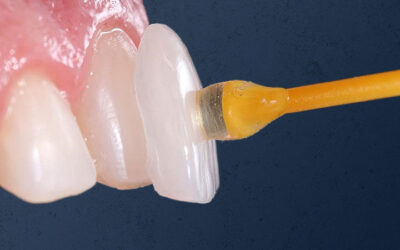 Facetas ou lentes dentais?