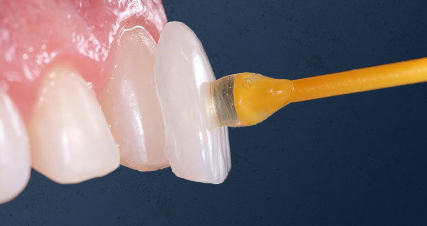 facetas ou lentes dentais