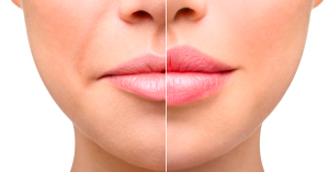 preenchimento labial