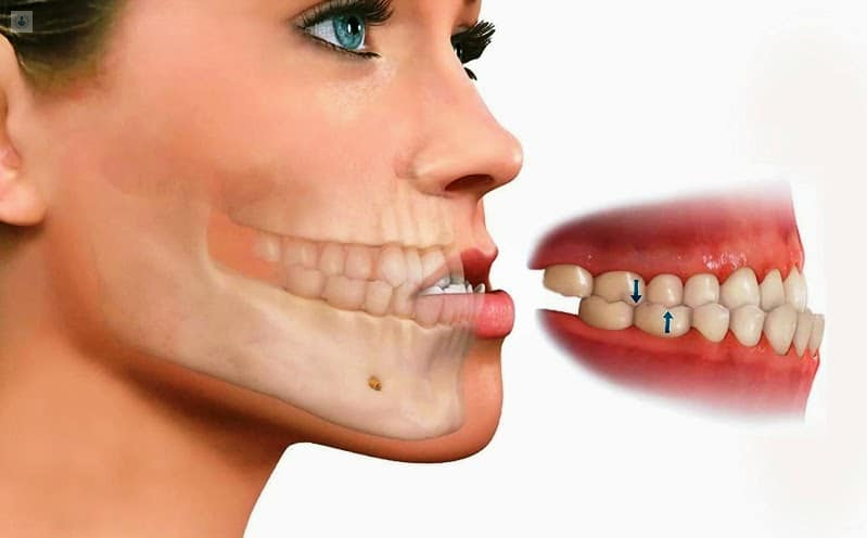 O que é o Prognatismo Mandibular