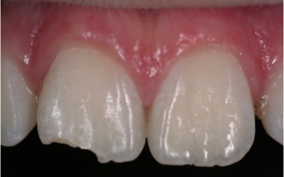 Dente quebrado: o que fazer