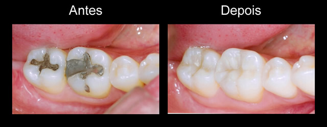 restauração antes depois - Dentista Porto Alegre - Zona Norte - Hera ...