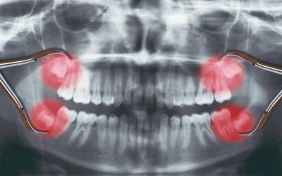 Cirurgia de Siso em Porto Alegre